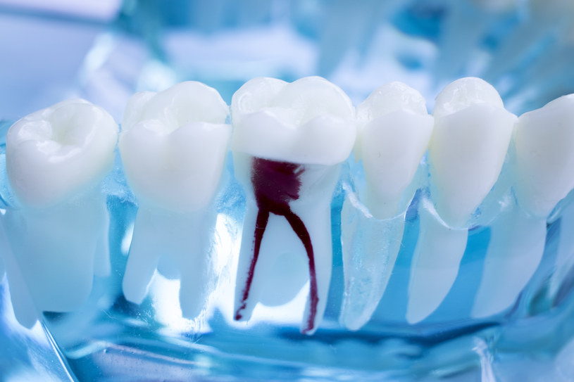 Model zęba, na którym stomatolodzy uczą się, jak leczyć kanały zębowe /123RF/PICSEL