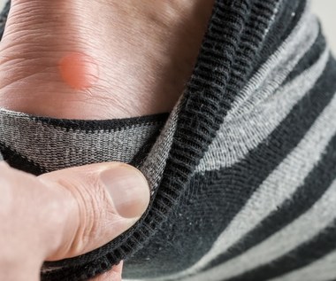 Modzele i odciski: Przyczyny i leczenie. Jak się ich pozbyć?