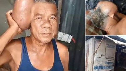 Mówią o nim "człowiek z dwiema głowami". "Chciałbym połknąć garść tabletek i się nie obudzić"