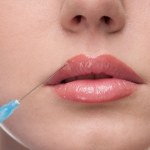 Na czym polega botoks