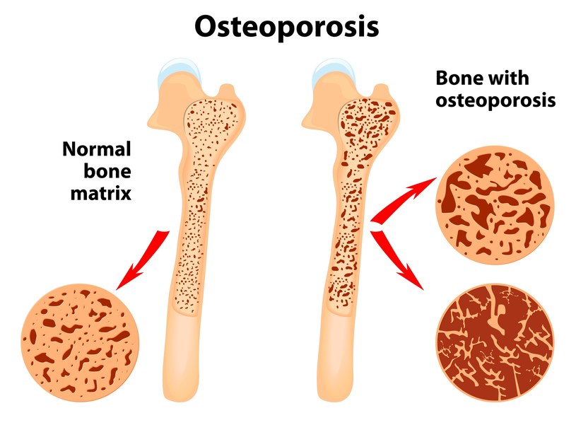 Na osteoporozę cierpią przede wszystkim osoby starsze /123/RF PICSEL