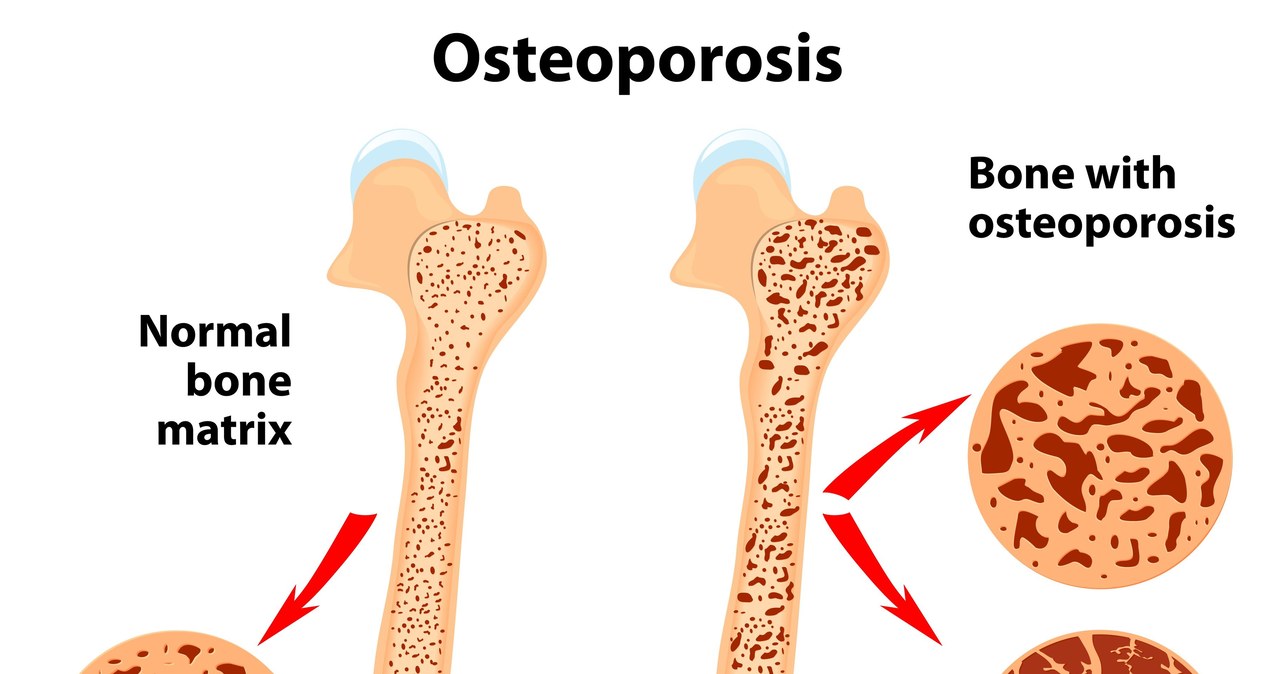 Na osteoporozę cierpią przede wszystkim osoby starsze /123/RF PICSEL