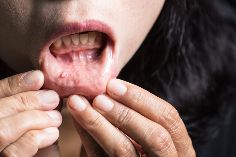 Na pierwsze objawy raka jamy ustnej pacjenci często nie zwracają uwagi /123RF/PICSEL