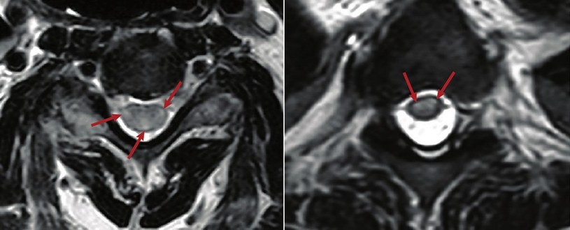 Na zdjęciach widać zapalenie rdzenia kręgowego /Fot. Frontiers in Immunology /materiały prasowe