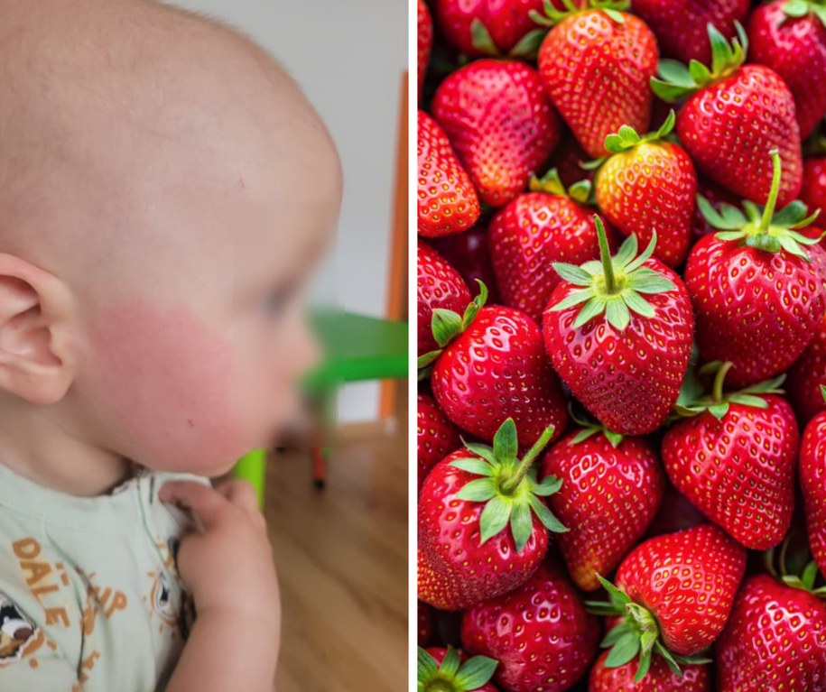 Na zdjęciu 2-letni chłopiec, u którego wystąpiły objawy skórne, po tym jak dzień wcześniej jadł truskawki /fotografia prywatna /Shutterstock