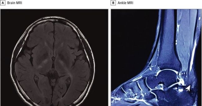Na zdjęciu MRI mózgu pacjenta (A) i kostki (B). Strzałka na zdjęciu B wskazuje powiększenie ścięgna Achillesa pacjenta, które zwęża się na końcu /Fot. JAMA Neurology /materiały prasowe