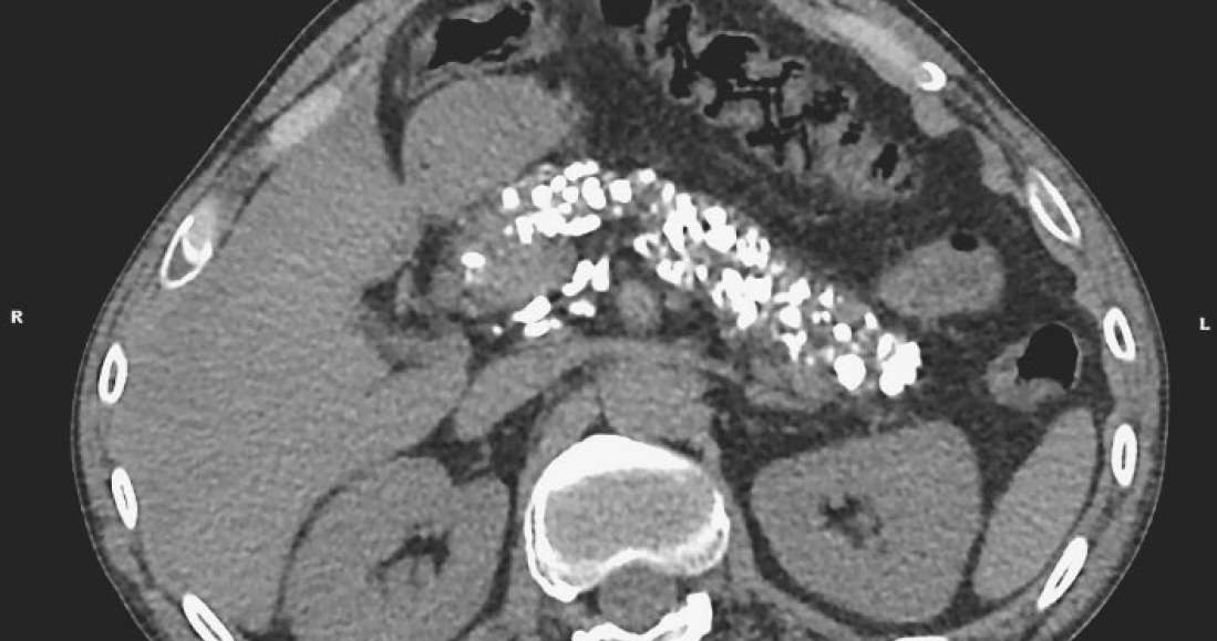 Na zdjęciu z CT widać zwapniałą trzustkę /materiały prasowe
