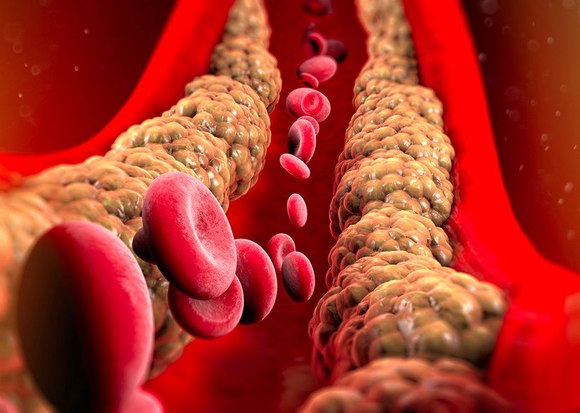 Nadmiar cholesterolu prowadzi do chorób układu krążenia. Jaką dietę stosować na wysoki cholesterol? /123rf.com /123RF/PICSEL
