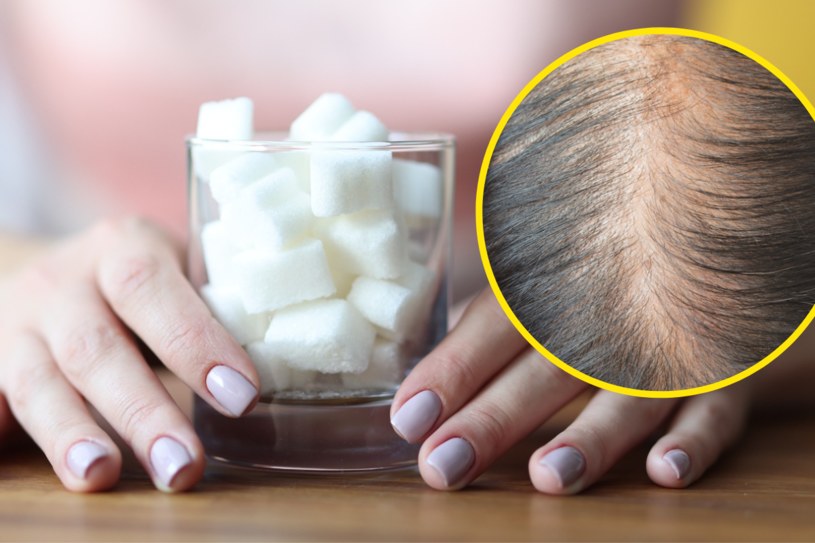 Nadmiar cukru w diecie może prowadzić do nagłej utraty włosów, w tym powoduje również łysienie androgenowe /123RF/PICSEL