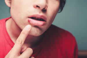 ​Nadżerki i owrzodzenia w jamie ustnej: Afty oraz pleśniawki 