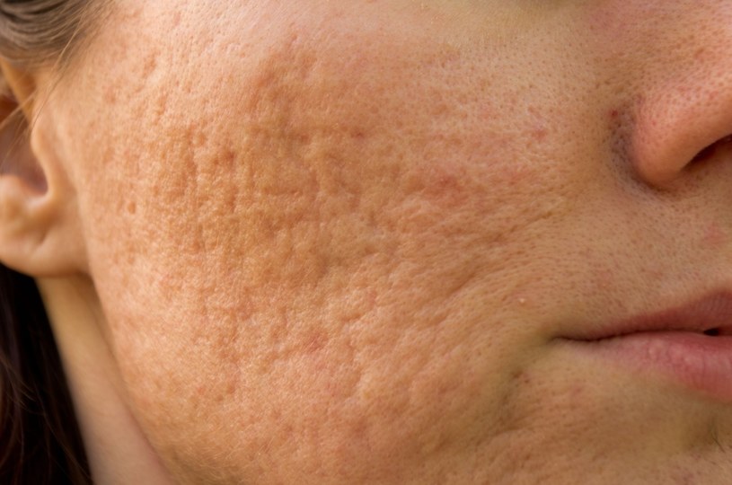 Najczęstszą przyczyną trądziku u osób dorosłych jest bardzo wrażliwa skóra /123RF/PICSEL