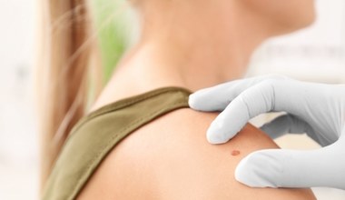 Najczęstsze miejsca występowania czerniaka. Inaczej jest u kobiet, inaczej u mężczyzn