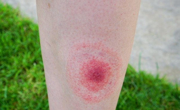 Najczęstsze objawy boreliozy 