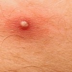 Najczęstsze zakażenia skórne: Jak sobie z nimi radzić?
