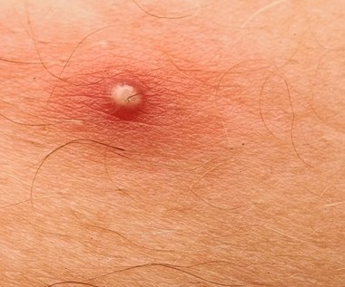 Najczęstsze zakażenia skórne: Jak sobie z nimi radzić?