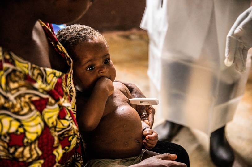 Najwięcej przypadków ospy małpiej odnotowuje się w Afryce /AFP