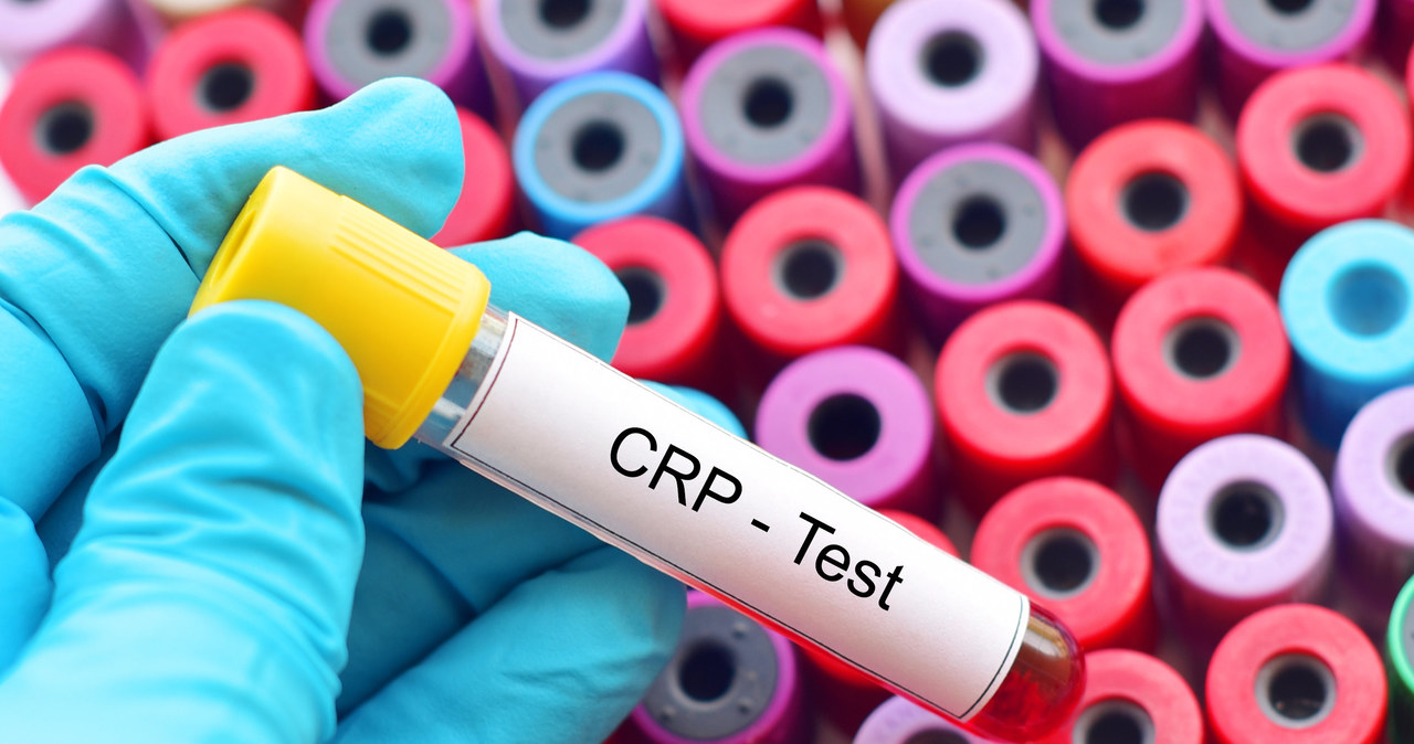 Najwyższe wartości CRP oznacza się w przypadku ostrego zapalenia trzustki powikłanego martwicą, rozległych oparzeń, martwicy tkanek i w uszkodzeniach wielonarządowych /123RF/PICSEL