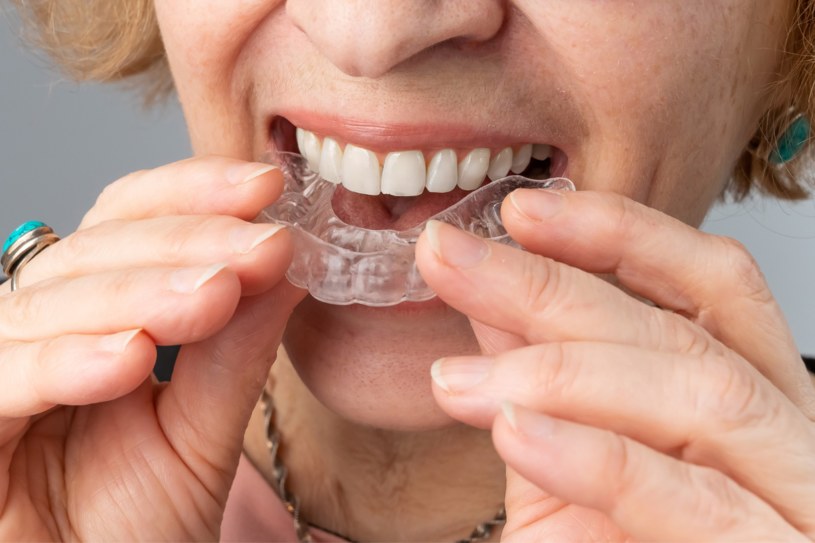 Nakładki prostujące zęby. U ortodonty - tak, na własną rękę - nie! /123RF/PICSEL