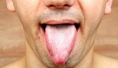 Nalot na języku. O czym mogą świadczyć zmiany w jamie ustnej?