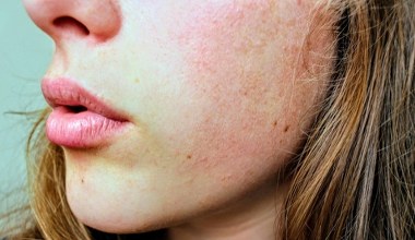 Naturalne składniki w walce ze spierzchniętymi ustami. Domowe triki działają najskuteczniej