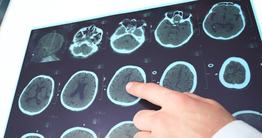 Naukowcom będzie teraz łatwiej namierzyć regiony mózgu odpowiedzialne za epilepsję /123RF/PICSEL