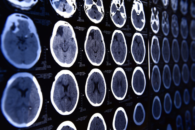 Naukowcom udało się wyłączyć odczuwanie bólu w mózgu pacjentów /123RF/PICSEL