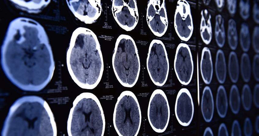 Naukowcom udało się wyłączyć odczuwanie bólu w mózgu pacjentów /123RF/PICSEL