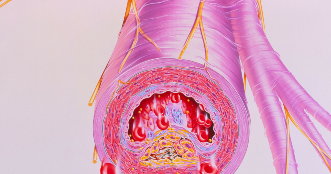 Naukowcy byli zdumieni. że bakterie z jamy ustnej mogą powodować zatykanie się tętnic /East News