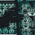 Naukowcy cofnęli objawy alzheimera. Nowa terapia na horyzoncie