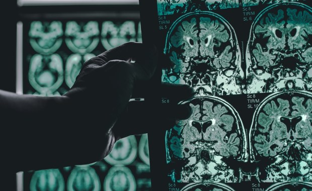 Naukowcy cofnęli objawy alzheimera. Nowa terapia na horyzoncie