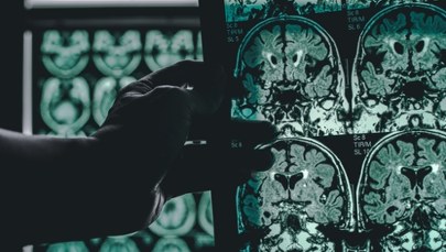 Naukowcy cofnęli objawy alzheimera. Nowa terapia na horyzoncie