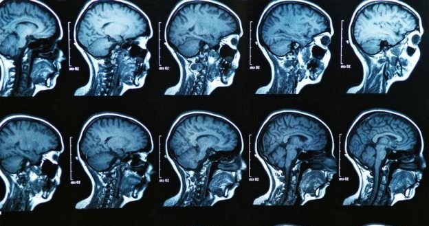 Naukowcy nie wiedzą co dolega Corbinowi Durantowi. Jego mózg stale się kurczy! /123RF/PICSEL