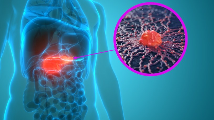 Naukowcy odkryli jak mechanizm, który umożliwia powstanie pierwszych guzów raka trzustki