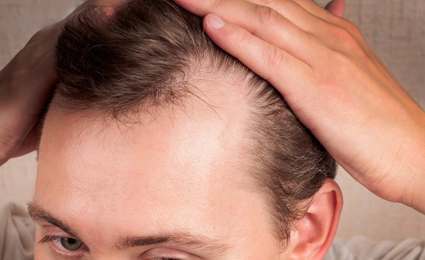 Naukowcy odkryli nowy sposób w walce z łysieniem. Wystarczy... słodzik