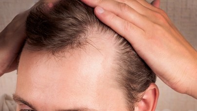 Naukowcy odkryli nowy sposób w walce z łysieniem. Wystarczy... słodzik