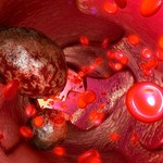 Naukowcy potwierdzają - tłuszcz to paliwo dla nowotworów