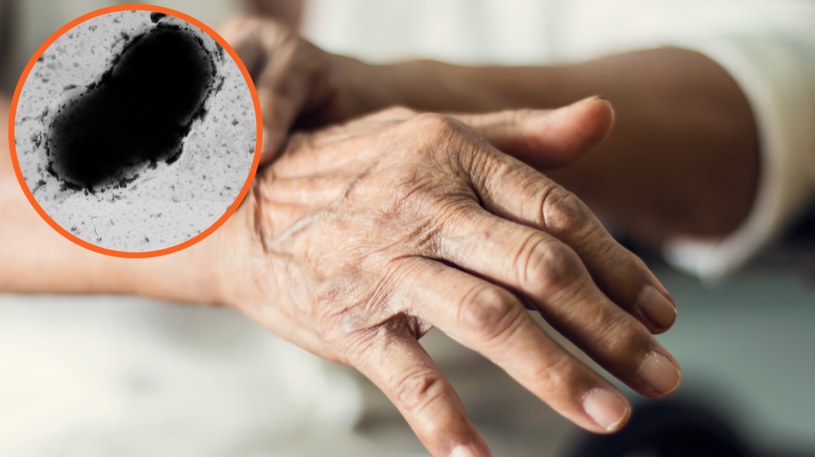 Naukowcy twierdzą, że Parkinson może być spowodowany przez rodzaj bakterii, który występuje u 80 proc. ludzi /Wikipedia: Graham Bradley, domena publiczna /123RF/PICSEL