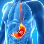Naukowcy wyodrębnili 3 podtypy raka żołądka