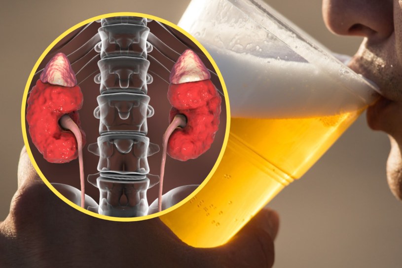 Nefrolog obala mit - piwo nie leczy nerek, a sam alkohol przyczynia się m.in. do dny moczanowej i cukrzycy /123RF/PICSEL