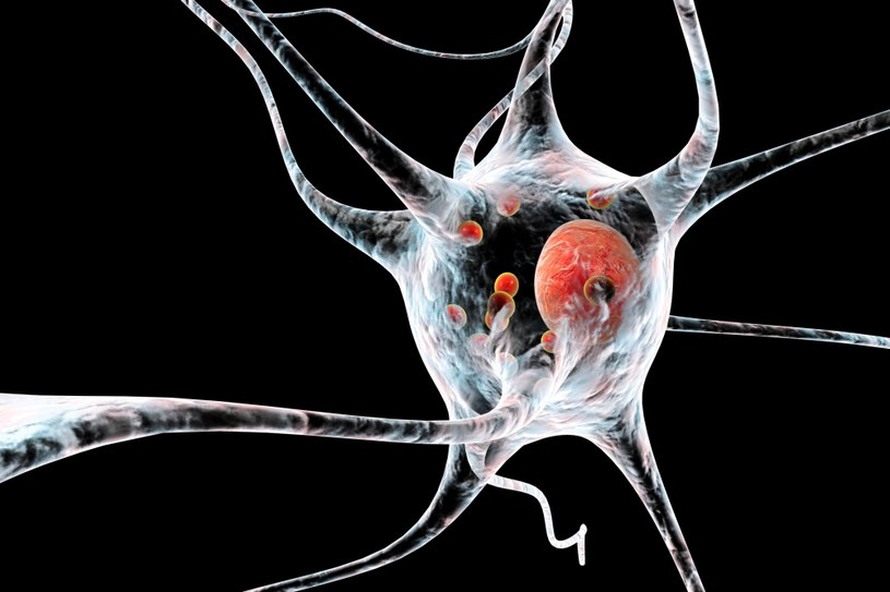 Neuron z ciałami Lewy'ego (czerwone) to charakterystyczny obraz choroby Parkinsona /123RF/PICSEL