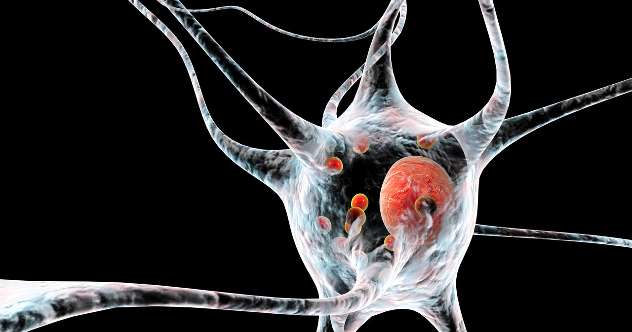 Neuron z ciałami Lewy'ego (czerwone) to charakterystyczny obraz choroby Parkinsona /123RF/PICSEL