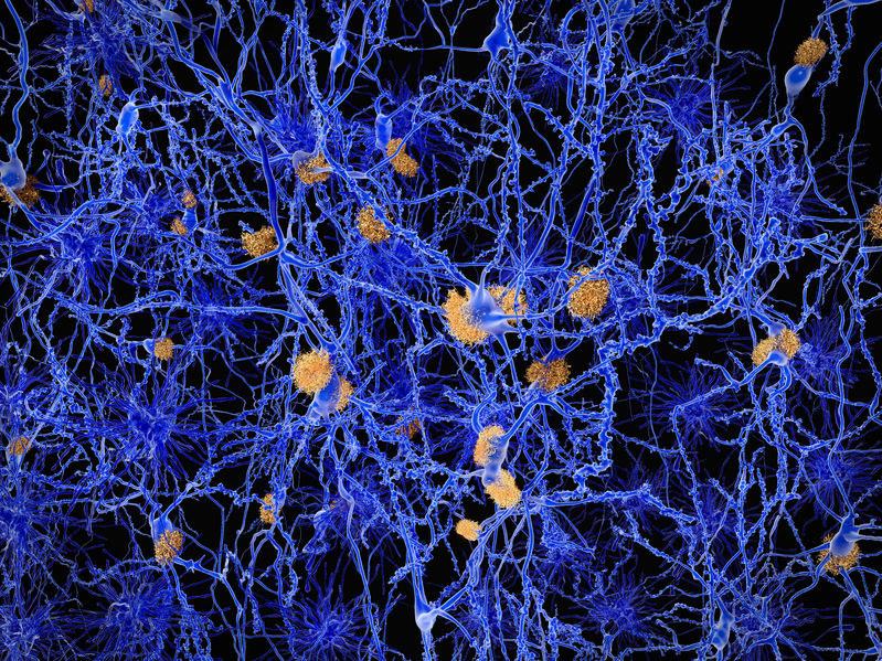 Neurony z blaszkami amyloidowymi /123RF/PICSEL