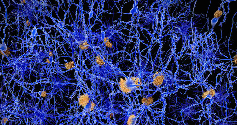 Neurony z blaszkami amyloidowymi /123RF/PICSEL