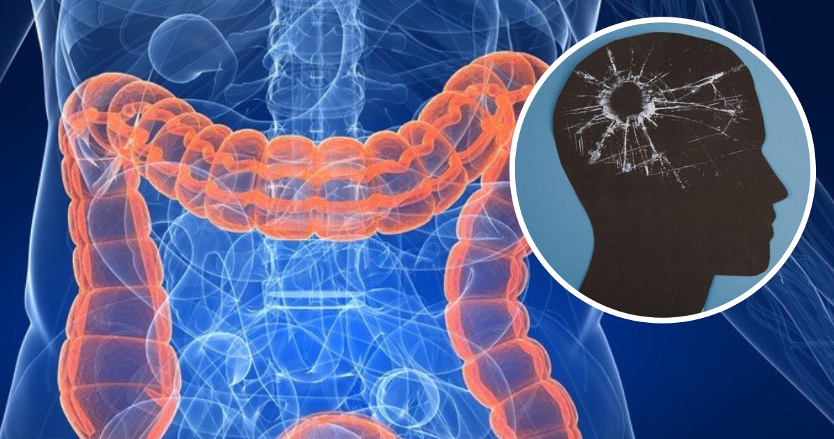 Neurotoksyny przedostają się z jelit do krwioobiegu, a następnie przekraczają barierę krew-mózg. Tam uszkadzają komórki nerwowe /123RF/PICSEL