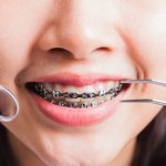 NFZ płaci za aparat ortodontyczny dziecka. Oto warunki, które trzeba spełnić