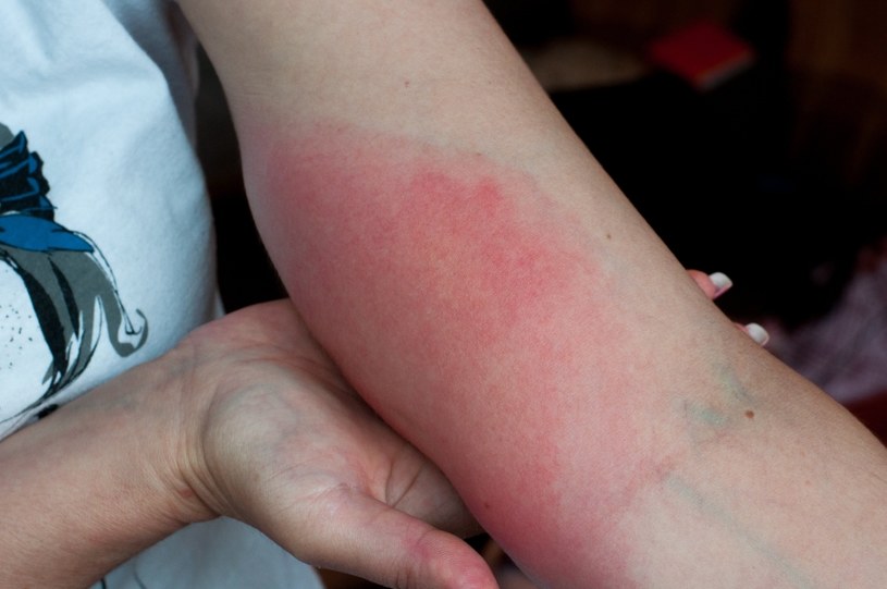 Nie bagatelizuj alergii. U osób uczulonych objawy obejmują nie tylko ból i obrzęk w miejscu ugryzienia /123RF/PICSEL