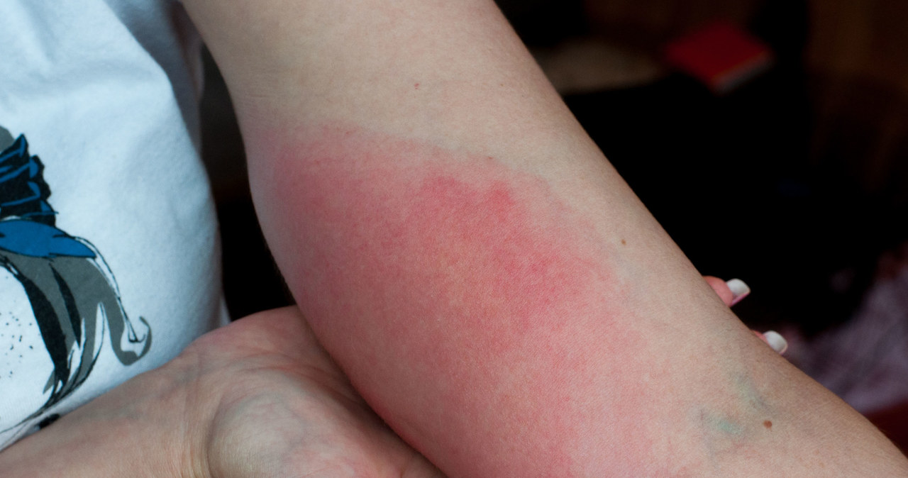Nie lekceważ takich plam na skórze, bo to może być silna reakcja alergiczna na ukąszenie meszek. Jeśli rumień nie znika, jak najszybciej udaj się do lekarza /123RF/PICSEL