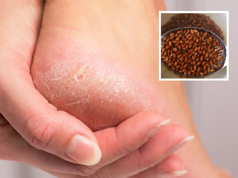 Nie ma lepszego sposobu na popękane pięty. Wymocz je w tym, a będą gładkie jak jedwab