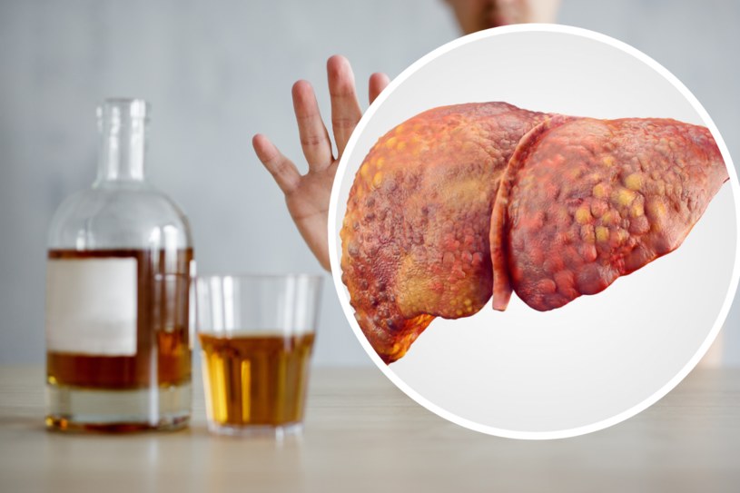 Nie trzeba być alkoholikiem by cierpieć na stłuszczenie lub niewydolność wątroby /123RF/PICSEL