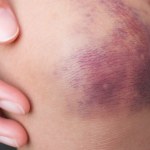 Nie znikały jej siniaki, trafiła do szpitala. Diagnoza zaskoczyła wszystkich